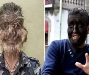Werewolf Syndrome