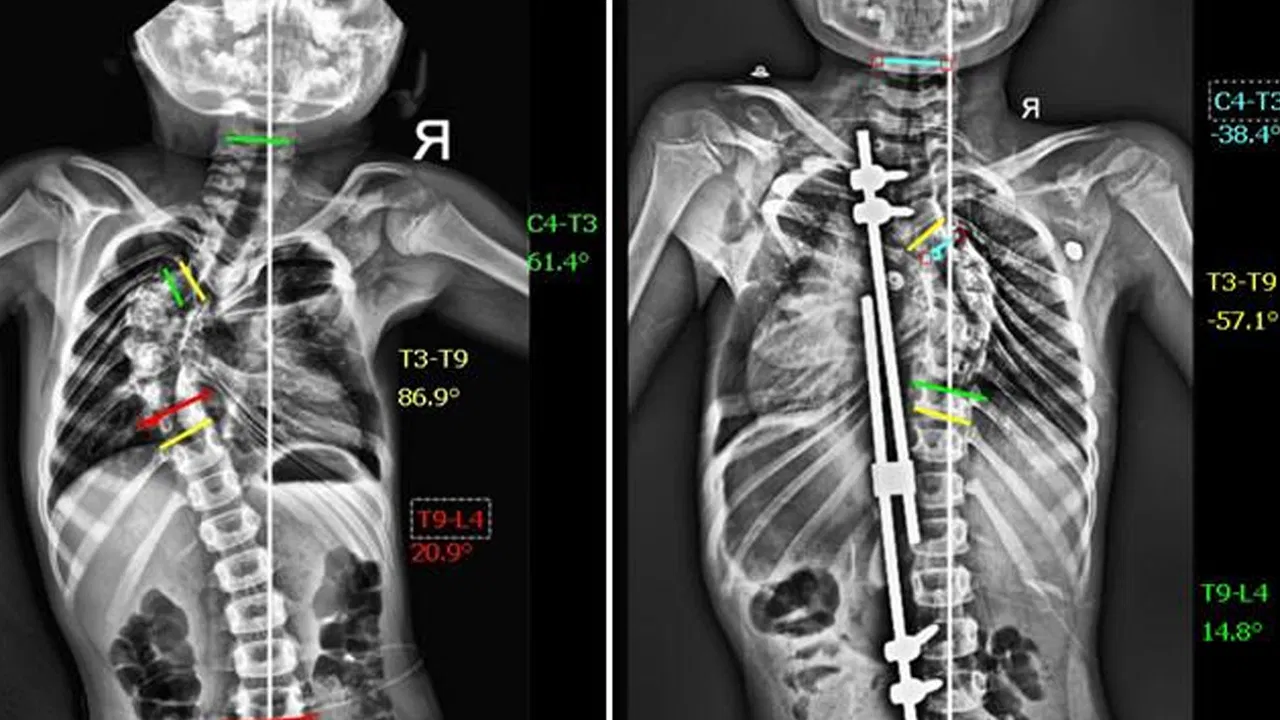 scoliosis-in-children