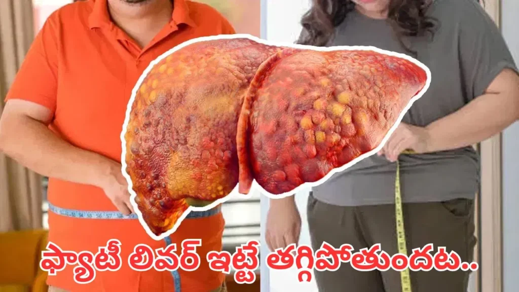 fatty-liver-1